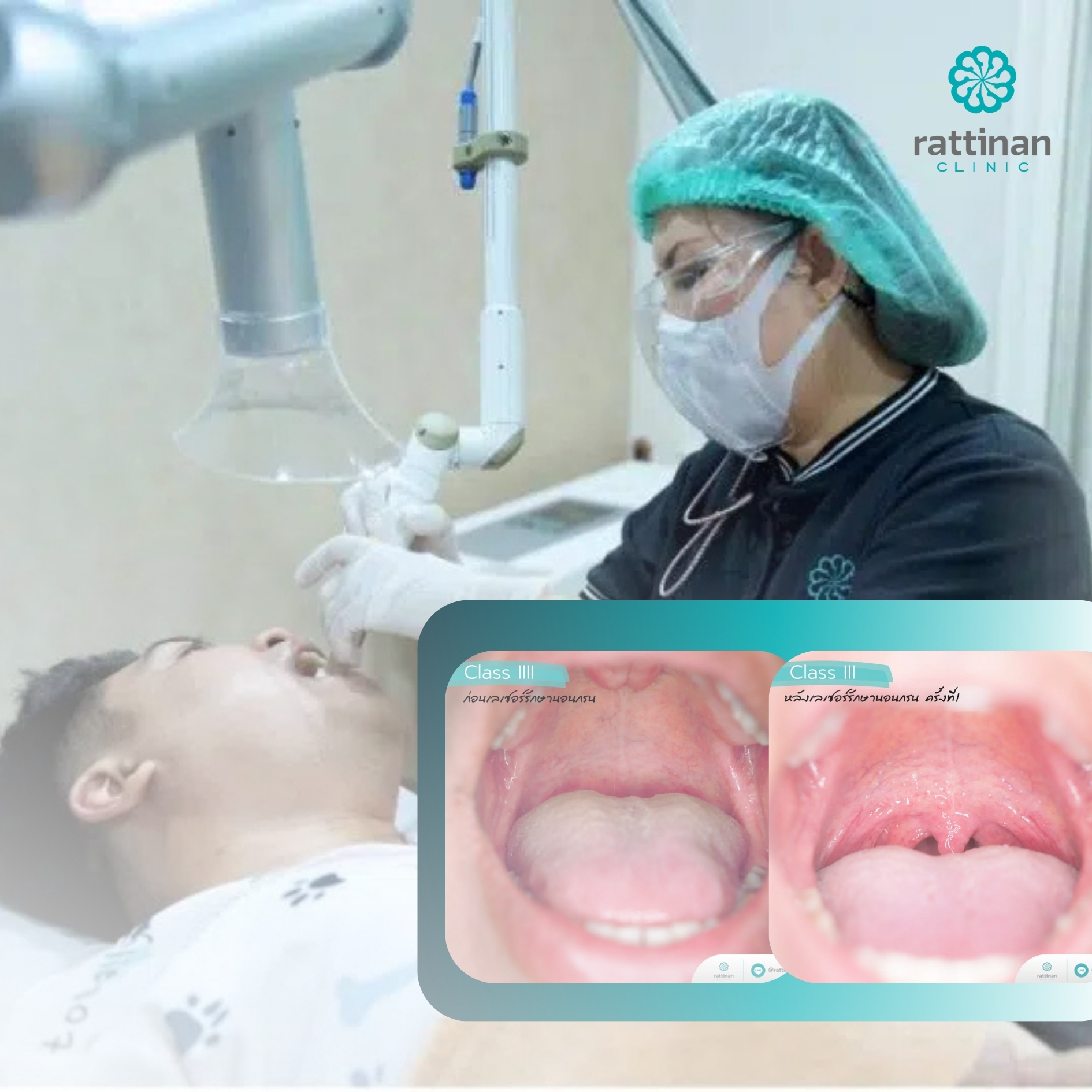 รีวิวเลเซอร์รักษานอนกรน รัตตินันท์ คลินิก