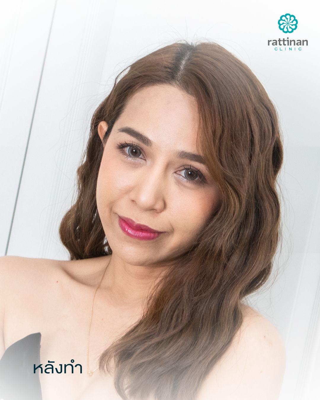 หลังทำ Morpheus8 Rattinan Clinic