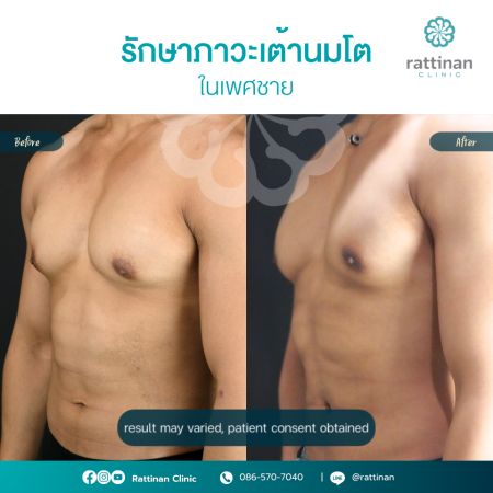 Gynecomastia Before After - Thrid