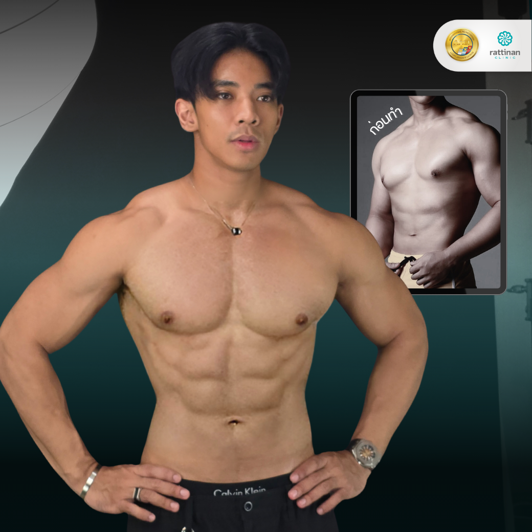 Gynecomastia Testimonial - 2 - Thrid
