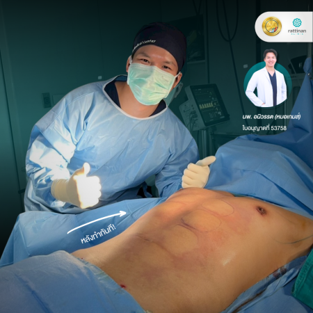 Gynecomastia Testimonial - 3 - Thrid
