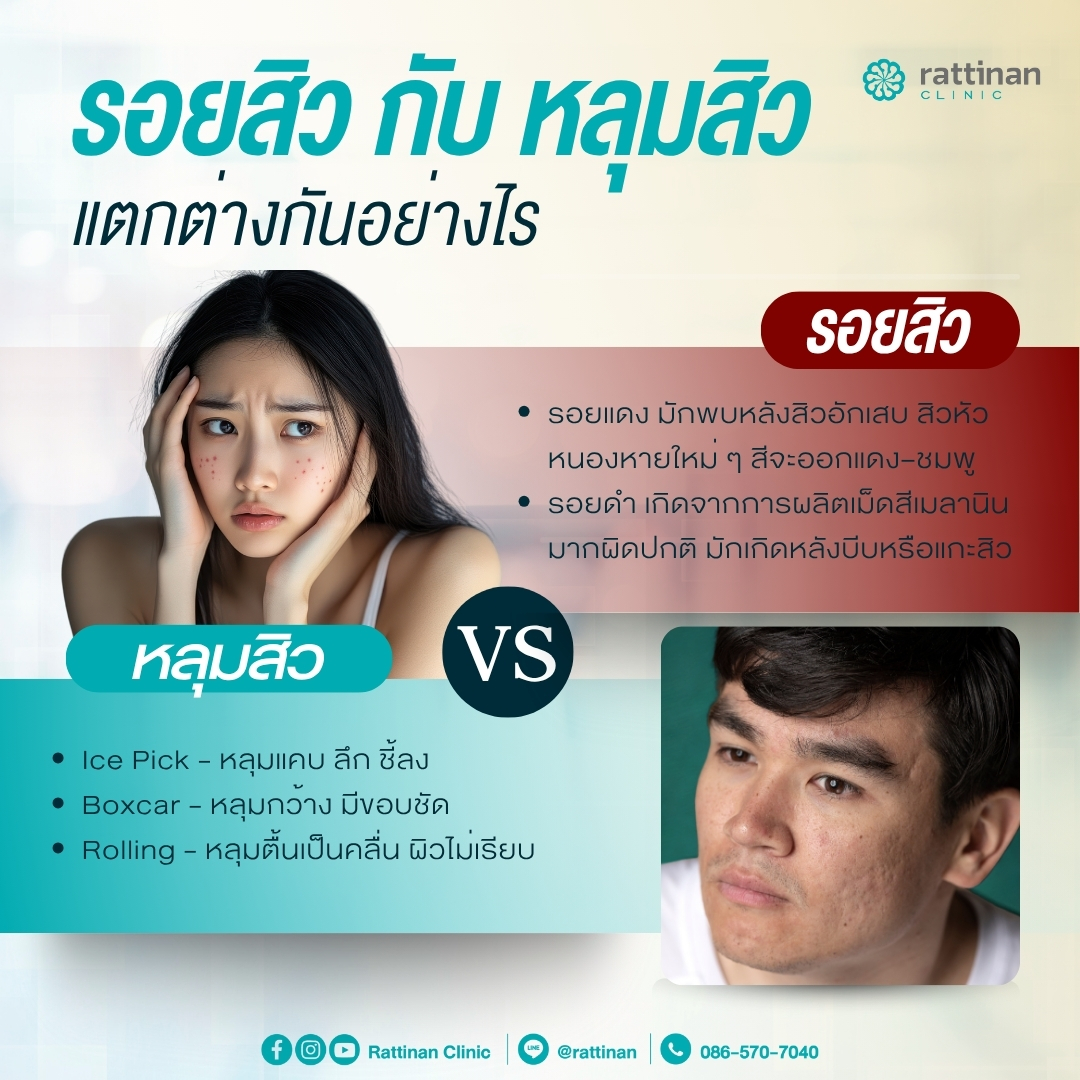 รอยสิว กับ หลุมสิว แตกต่างกันอย่างไร