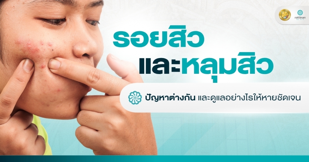 รอยสิว และ หลุมสิว ดูแลอย่างไรให้หายชัดเจน