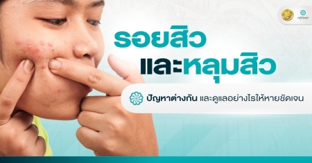 รอยสิว และ หลุมสิว ดูแลอย่างไรให้หายชัดเจน