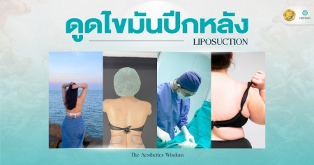 ดูดไขมันปีกหลัง