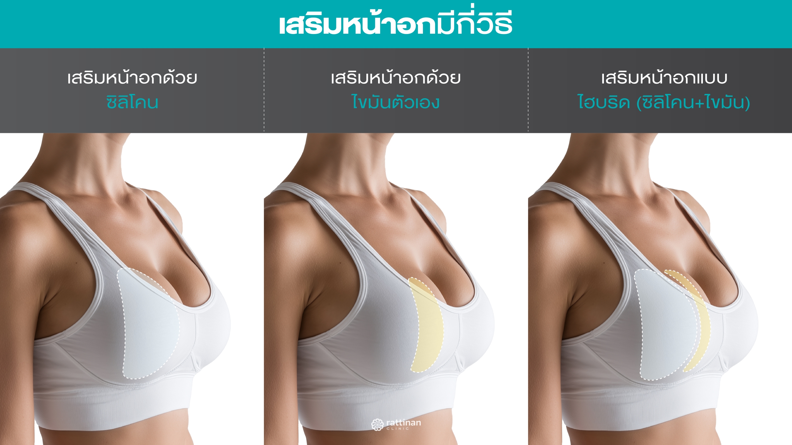 เสริมหน้าอกมีกี่วิธี แตกต่างกันอย่างไร