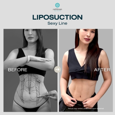 รีวิวดูดไขมัน sexy line รัตตินันท์ คลินิก