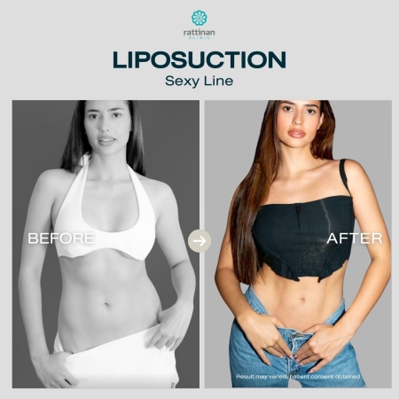 รีวิวดูดไขมัน sexy line รัตตินันท์ คลินิก