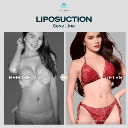 รีวิวดูดไขมัน sexy line รัตตินันท์ คลินิก
