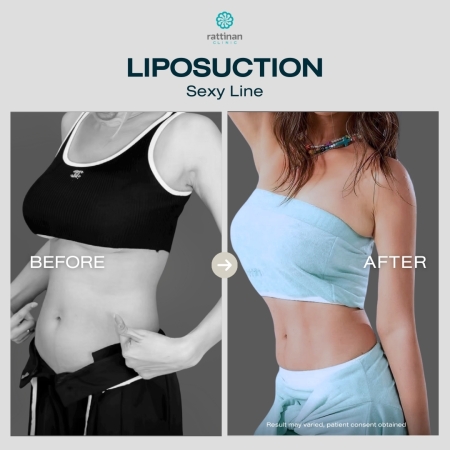 รีวิวดูดไขมัน sexy line รัตตินันท์ คลินิก
