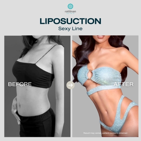 รีวิวดูดไขมัน sexy line รัตตินันท์ คลินิก