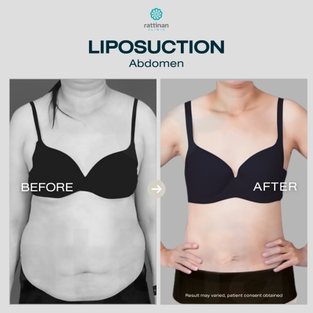 รีวิวดูดไขมัน หน้าท้อง รัตตินันท์ คลินิก