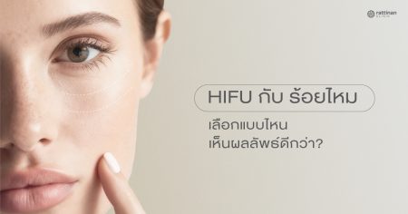 Hifu กับ ร้อยไหม