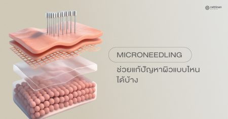 Microneedling คืออะไร?