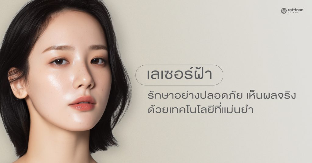 เลเซอร์ฝ้า