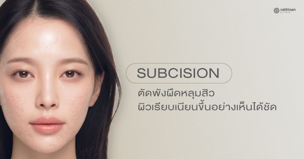 Subcision ตัดพังผืดหลุมสิว