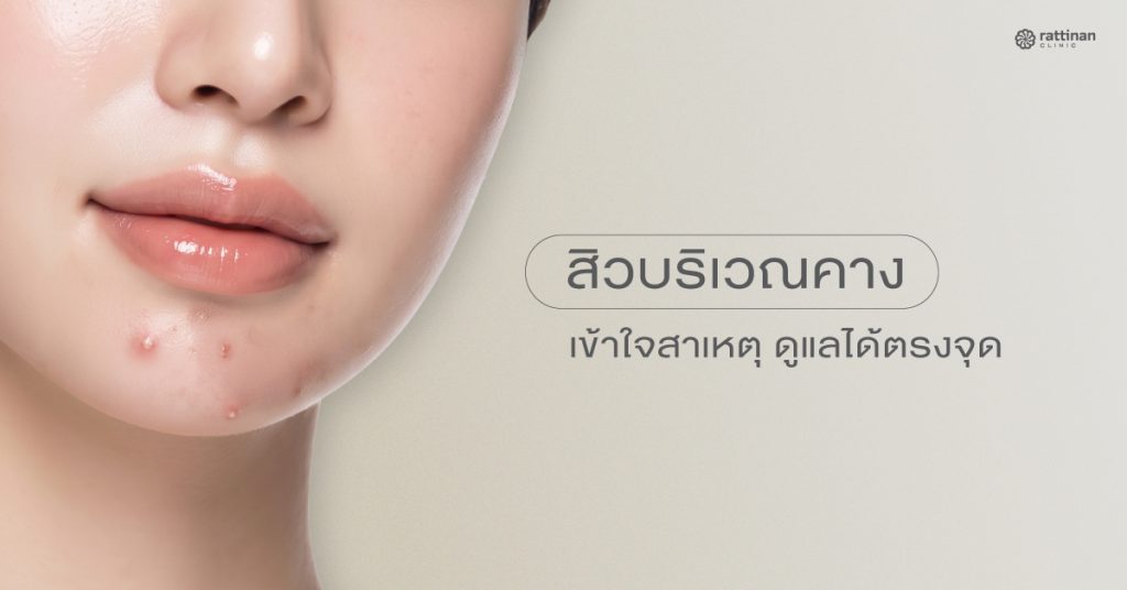สิวขึ้นคาง