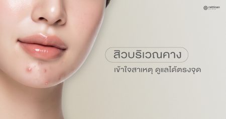 สิวขึ้นคาง